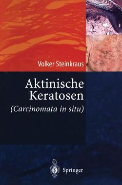 Aktinische Keratosen (Carcinomata in situ) von Steinkraus,  Volker