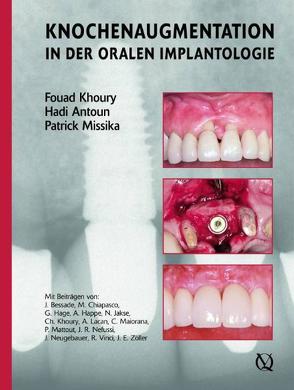 Augmentive Verfahren in der oralen Implantogie  von Khoury,  Fouad