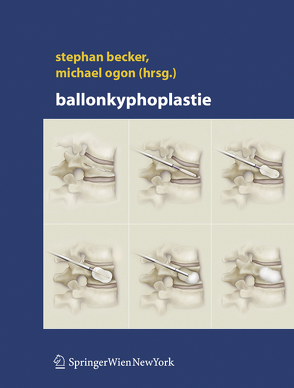 Ballonkyphoplastie von Becker,  Stephan, Ogon,  Michael