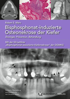 Bisphosphonat-induzierte Osteonekrose der Kiefer von Marx,  Robert E.