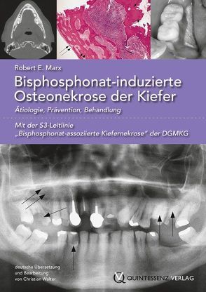 Bisphosphonat-induzierte Osteonekrose der Kiefer von Marx,  Robert E.