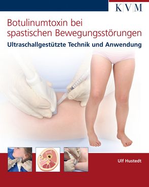 Botulinumtoxin bei spastischen Bewegungsstörungen von Hustedt,  Ulf