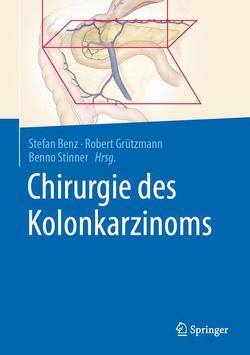 Chirurgie des Kolonkarzinoms von Benz,  Stefan, Grützmann,  Robert, Stinner,  Benno