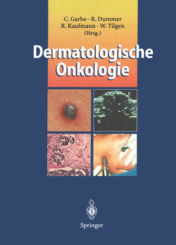 Dermatologische Onkologie von Dummer,  Reinhard, Garbe,  Claus, Kaufmann,  Roland, Tilgen,  Wolfgang