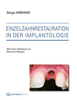 Einzelzahnrestauration in der Implantologie von Armand,  Serge