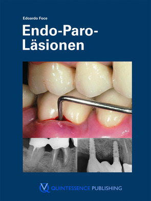 Endo-Paro-Läsionen von Foce,  Edoardo