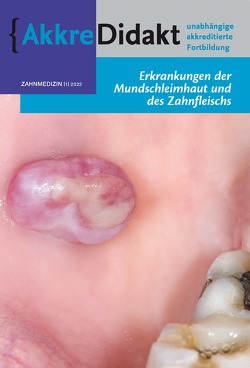 Erkrankung der Mundschleimhaut und des Zahnfleisches von van der Waal,  Isaäc
