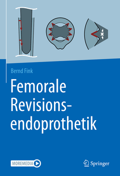 Femorale Revisionsendoprothetik von Fink,  Bernd