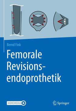 Femorale Revisionsendoprothetik von Fink,  Bernd