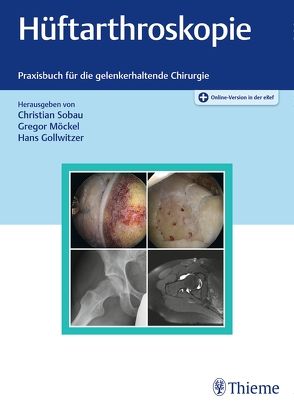 Hüftarthroskopie von Gollwitzer,  Hans, Möckel,  Gregor, Sobau,  Christian
