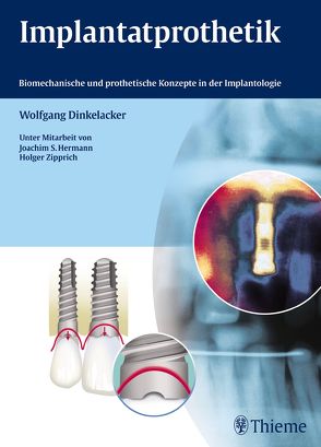 Implantatprothetik von Dinkelacker,  Wolfgang