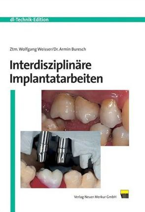 Interdisziplinäre Implantatarbeiten von Buresch,  Armin, Weisser,  Wolfgang