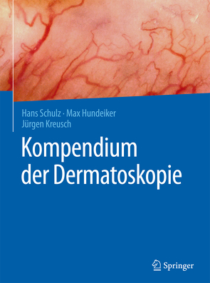 Kompendium der Dermatoskopie von Hundeiker,  Max, Kreusch,  Jürgen, Schulz,  Hans