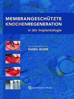 Membrangeschützte Knochenregeneration in der Implantologie von Buser,  Daniel