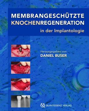 Membrangeschützte Knochenregeneration in der Implantologie von Bornstein,  M. M., Bosshardt,  D. D., Buser,  D, Buser,  Daniel, Chen,  S. T., Rocchietta,  I., Schenk,  R.K., Simion,  M., Storgård Jensen,  S., von Arx,  Th.