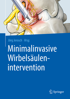 Minimalinvasive Wirbelsäulenintervention von Jerosch,  Jörg