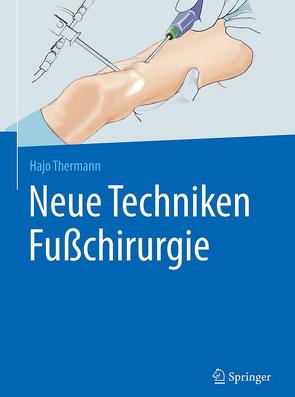 Neue Techniken Fußchirurgie von Thermann,  Hajo