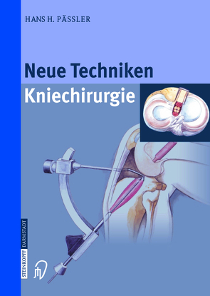 Neue Techniken Kniechirurgie von Pässler,  H.H., Thermann,  H.