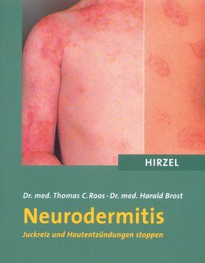 Neurodermitis von Brost,  Harald, Roos,  Thomas C.