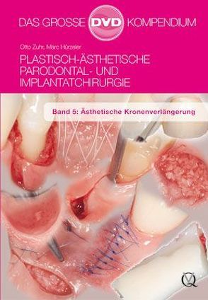 Plastisch-Ästhetische Parodontal- und Implantatchirurgie von Hürzeler,  Marc, Zuhr,  Otto