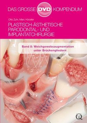 Plastisch-Ästhetische Parodontal- und Implantatchirurgie / Plastisch-Ästhetische Parodontal- und Implantatchirurgie von Hürzeler,  Marc, Zuhr,  Otto