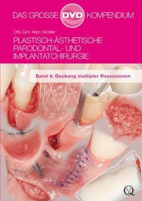 Plastisch-Ästhetische Parodontal- und Implantatchirurgie von Hürzeler,  Marc, Zuhr,  Otto