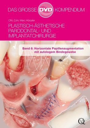 Plastisch-Ästhetische Parodontal- und Implantatchirurgie von Hürzeler,  Zuhr, Zuhr,  Otto