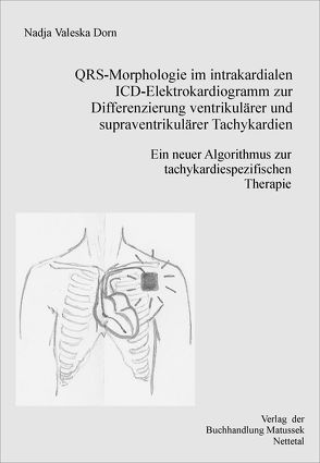QRS-Morphologie im intrakardialen ICD-Elektrokardiogramm zur Differenzierung supraventrikulärer von ventrikulären Tachykardien von Dorn,  Nadja V