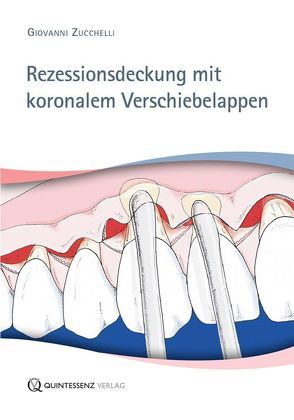 Rezessionsdeckung mit koronalem Verschiebelappen von Zucchelli,  Giovanni