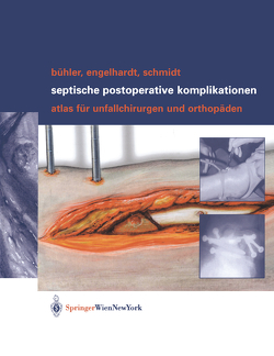 Septische postoperative Komplikationen von Bühler,  Matthias, Engelhardt,  Martin, Schmidt,  Hergo G.K.