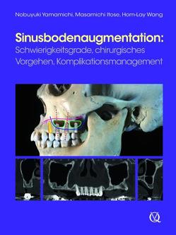 Sinusbodenaugmentation von Itose,  Masamichi, Wang,  Hom-Lay, Yamamichi,  Nobuyuki