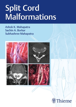 Split Cord Malformations von Borkar,  Sachin, Mahapatra,  Ashok, Mahapatra,  Subhashree