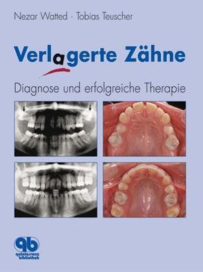Verlagerte Zähne von Teuscher,  Tobias, Watted,  Nezar